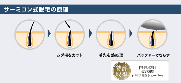 サーミコン式脱毛の原理