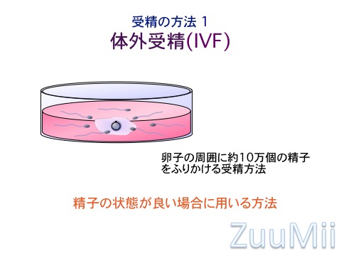 IVF