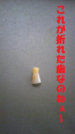 もろくも折れたオイラの歯…