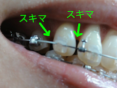 上前歯の隙間2