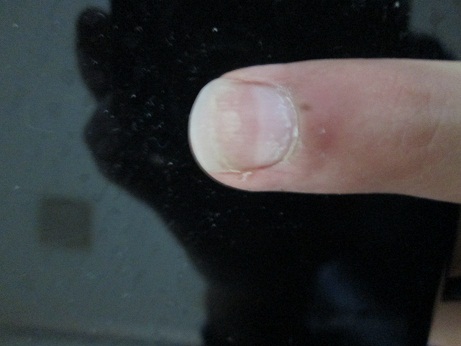 爪甲剥離症の左手薬指